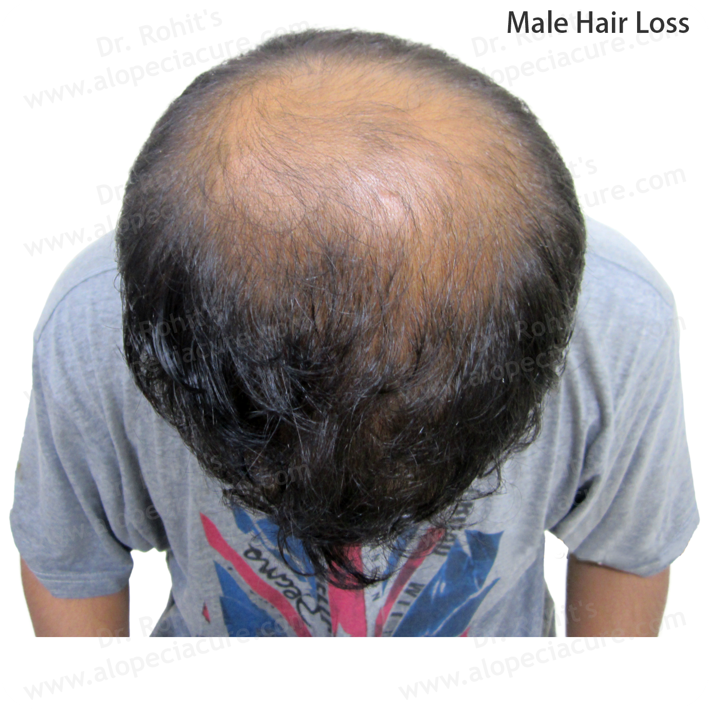 Male Hair Loss Clinical Treatment